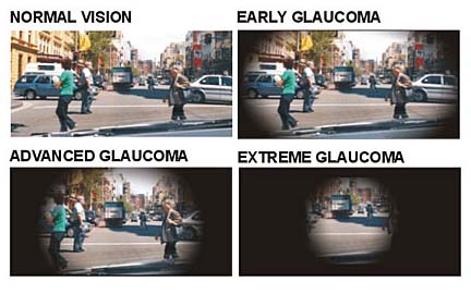 Glaucoma