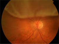 Retinal Detachment(RD)