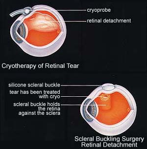 Retinal Detachment(RD)