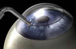 NearVisionSM CK (Conductive Keratoplasty)