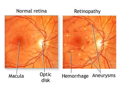 Diabetes and the Eye